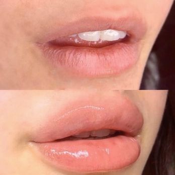 Brow Babes - Hyaluronic pen - Permanent Makeup Near Me - Irving, Texas Brow Babes - Hyaluronic pen - Permanent Makeup Near Me - Irving, Texas