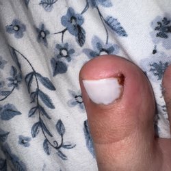 Modern Nail - Infected toenail