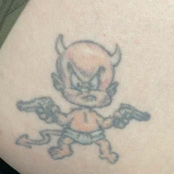 Clean Canvas Laser - about to start tattoo removal on this little guy - Tattoo Removal Near Me - Houston, Texas Clean Canvas Laser - about to start tattoo removal on this little guy - Tattoo Removal Near Me - Houston, Texas