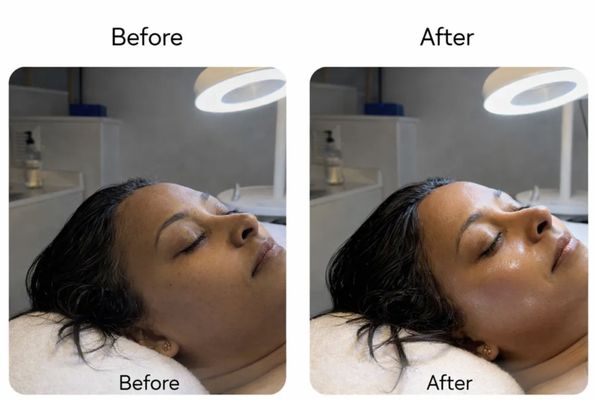 HydraFacial Results! - Every skin is unique. At Silky Skin, we offer personalized beauty treatments and pampering services that cater to your individual skin care needs and preferences for a flawless complexion. Please message or call us to book your appointment today! HydraFacial Results! - Every skin is unique. At Silky Skin, we offer personalized beauty treatments and pampering services that cater to your individual skin care needs and preferences for a flawless complexion. Please message or call us to book your appointment today!