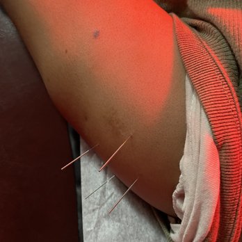 Green Acupunture - For one of pain relief points - Acupuncture Near Me - Oxnard, California Green Acupunture - For one of pain relief points - Acupuncture Near Me - Oxnard, California