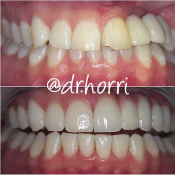 Horri Aesthetic Reconstructive Dentistry - Sports Injury Makeover - General Dentistry Near Me - New York, New York Horri Aesthetic Reconstructive Dentistry - Sports Injury Makeover - General Dentistry Near Me - New York, New York