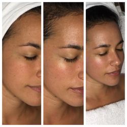 Beach Beauty Booth - Vitamin A&C Facial, before and after