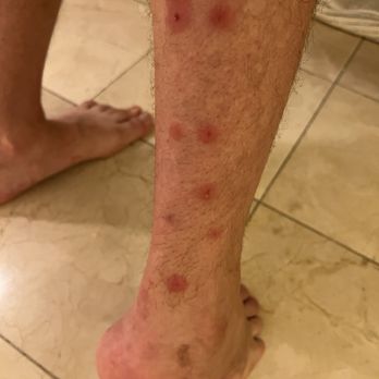 Koshkakaryan Law, APC - Bed bugs bites - Personal Injury Law Near Me - Glendale, California Koshkakaryan Law, APC - Bed bugs bites - Personal Injury Law Near Me - Glendale, California