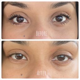 Before is top photo and 2 weeks after tear filler is bottom photo. My left eye looks worse than before. Before is top photo and 2 weeks after tear filler is bottom photo. My left eye looks worse than before.