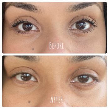 Tacoma Laser Clinic - Before is top photo and 2 weeks after tear filler is bottom photo. My left eye looks worse than before. - Medical Spas Near Me - Tacoma, Washington Tacoma Laser Clinic - Before is top photo and 2 weeks after tear filler is bottom photo. My left eye looks worse than before. - Medical Spas Near Me - Tacoma, Washington