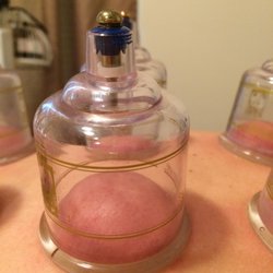 The Village Acupuncturist - Cupping- my first time. Very interesting!