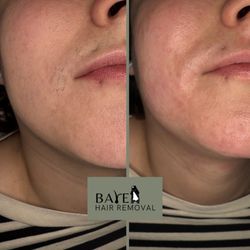 Bare Hair Removal - Upper lip/chin/jaw session before and after