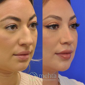 Mehta Plastic Surgery - Cosmetic Surgeons Near Me - Menlo Park, California Mehta Plastic Surgery - Cosmetic Surgeons Near Me - Menlo Park, California