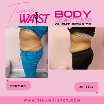 TinyWaist - Body Contouring Near Me TinyWaist - Body Contouring Near Me