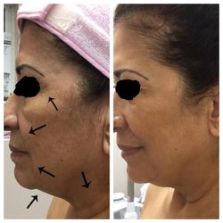 Eternal Youth Skincare - Antes y después (tratamientos para levantar el rostro y disminuir arrugas)