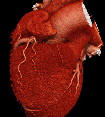 We used advanced imaging to screen and diagnose patients. Dr. Quesada reviews the images with all his patients. - Dr. Quesada offers access to on-site state-of-the-art computed tomography, positron emission tomography, single-photon emission tomography, and ultrasounds of the heart to our clinic. Clear and precise images of the heart in motion allow your doctors to make more precise diagnoses and better plan surgical procedures. We used advanced imaging to screen and diagnose patients. Dr. Quesada reviews the images with all his patients. - Dr. Quesada offers access to on-site state-of-the-art computed tomography, positron emission tomography, single-photon emission tomography, and ultrasounds of the heart to our clinic. Clear and precise images of the heart in motion allow your doctors to make more precise diagnoses and better plan surgical procedures.