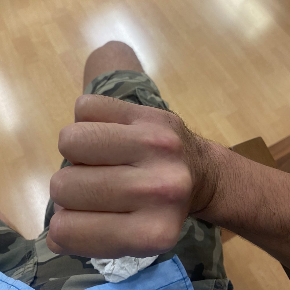 Modern Orthopedics PC - Another angle of my collapsed pinky knuckle. - Orthopedists Near Me - Los Gatos, California