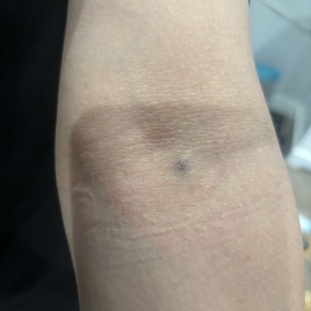 Es como quedó el brazo de mi hija en el momento de que la pincharon