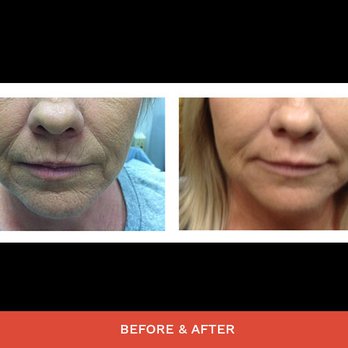 Your Time Medi Spa - Microneedling, reduces pore size, decreases melasma, and scarring, love this treatment - Medical Spas Near Me - Scottsdale, Arizona Your Time Medi Spa - Microneedling, reduces pore size, decreases melasma, and scarring, love this treatment - Medical Spas Near Me - Scottsdale, Arizona