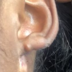Stacey June, DO FACOS - Missing earlobe