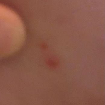 Hampton Inn & Suites Phoenix Tempe - Another bed bug bite!! - Hotels Near Me - Tempe, Arizona