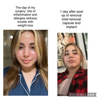 The Sculpting Spa - Best decision ever ' Explant  my before 2 days in - Body Contouring Near Me - Merced, California