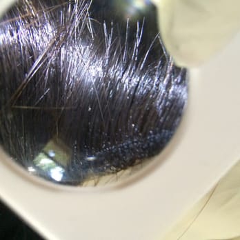 Pictures Of What I Assume To Be Dead Lice Nits On Lavish Ar