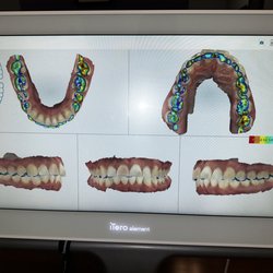 Bristol Dental & Orthodontics - 3D digital impression and scan to point out pressure spots on teeth