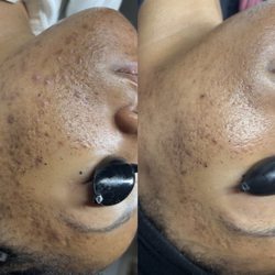 The Juvinex Room - Acne bootcamp ( September- December progress)