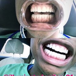 Illuminated Smiles - Triple Whitening Session 3-twenty minute sessions under the LED Laser light