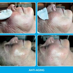 Mags and Marks Beauty - Procell Microchanneling for wrinkles, scars, and overall skin health