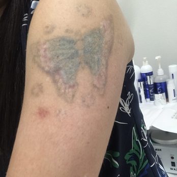 Kristin J Tarbet, MD - Hyper-pigment damage - Cosmetic Surgeons Near Me - Bellevue, Washington Kristin J Tarbet, MD - Hyper-pigment damage - Cosmetic Surgeons Near Me - Bellevue, Washington