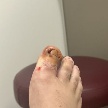 Renew Podiatry - Ingrown toenail has be numbed and prepped for surgery. - Podiatrists Near Me - Orange, California Renew Podiatry - Ingrown toenail has be numbed and prepped for surgery. - Podiatrists Near Me - Orange, California