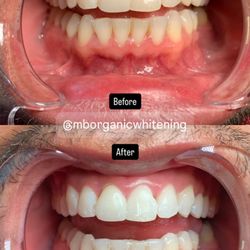 M&B Organic Whitening - Before and after using M&B Organic Whitening!