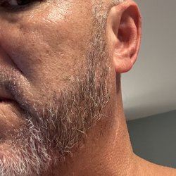 Virginia Surgical Hair Center - Left Side