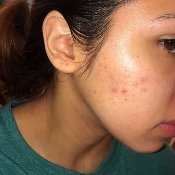 Affiliated Dermatology - breakouts - Dermatologists Near Me - Tempe, Arizona