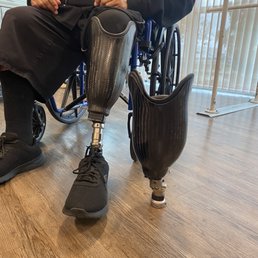 First prothesis was a bit heavy, hard to handle (on the floor). The new prothesis (I'm wearing) fits like a glove and is much lighter! First prothesis was a bit heavy, hard to handle (on the floor). The new prothesis (I'm wearing) fits like a glove and is much lighter!