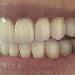 Boca Raton Cosmetic Dentist - Smile makeover
