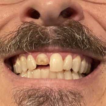EMA Dental - My broken front tooth - Cosmetic Dentists Near Me - East Longmeadow, Massachusetts EMA Dental - My broken front tooth - Cosmetic Dentists Near Me - East Longmeadow, Massachusetts