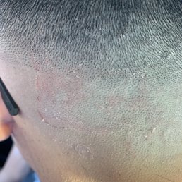 His blades did this to my sons back hair His blades did this to my sons back hair