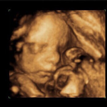 Peek A Belly 3D - Diagnostic Imaging Near Me - Lockport, Illinois