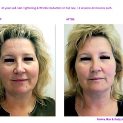 Reviva Skin and Body Solutions - Face tightening and wrinkle reduction with Radio Frequency.