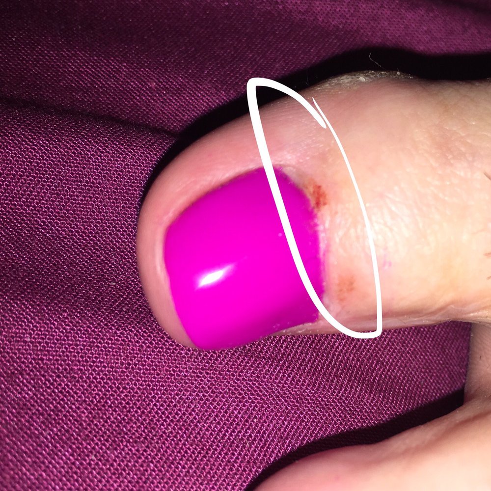 Crescent Nail and Spa - Cut & raw cuticle after bleeding - Nail Salons Near Me - Vancouver, British Columbia Crescent Nail and Spa - Cut & raw cuticle after bleeding - Nail Salons Near Me - Vancouver, British Columbia