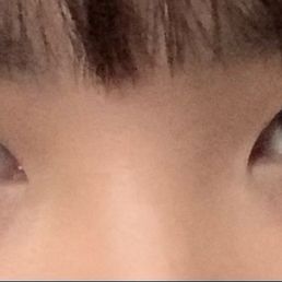 pre-procedure eyes. right lid occasionally loses the crease and becomes monolidded but otherwise looked fairly fine pre-procedure eyes. right lid occasionally loses the crease and becomes monolidded but otherwise looked fairly fine