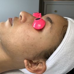 Skin Nutritious Holistic Acne Clinic - After 3 months