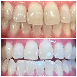 Deebeaut - Whiter teeth!!! Thank you Irina. It only took an hour. It was easy and painless.