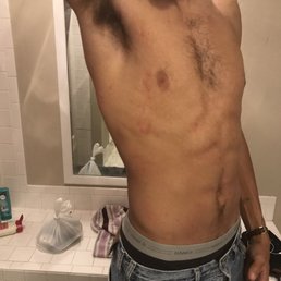 Bed bug bites Bed bug bites