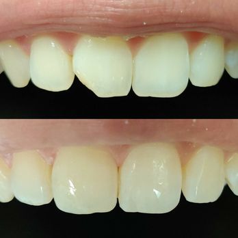 Daybreak Dental - Top: before Bottom: after - Endodontists Near Me - Battle Ground, Washington Daybreak Dental - Top: before Bottom: after - Endodontists Near Me - Battle Ground, Washington