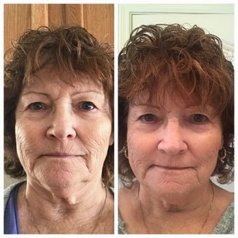 California Cryo - Procell Therapies, Microchanneling Advanced Anti-aging - Body Contouring Near Me - Jamestown, California California Cryo - Procell Therapies, Microchanneling Advanced Anti-aging - Body Contouring Near Me - Jamestown, California