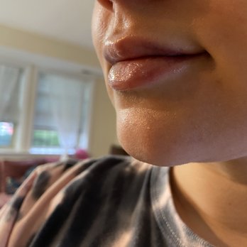 Congressional Plastic Surgery | Christopher C. Chang, M.D - 2nd day post-op. Minimal bruising and beautiful full lips! - Cosmetic Surgeons Near Me - Vienna, Virginia Congressional Plastic Surgery | Christopher C. Chang, M.D - 2nd day post-op. Minimal bruising and beautiful full lips! - Cosmetic Surgeons Near Me - Vienna, Virginia