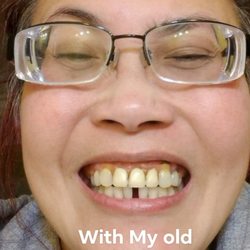 Pannu Dental Group - With my old Denture on top