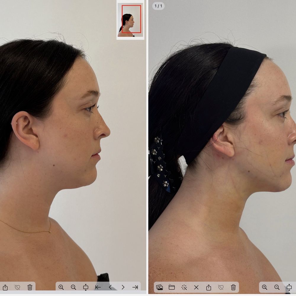 Pre / 48 hour post-op chin liposuction Pre / 48 hour post-op chin liposuction