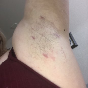 Artemedica - Left arm pit. - Medical Spas Near Me - Santa Rosa, California Artemedica - Left arm pit. - Medical Spas Near Me - Santa Rosa, California
