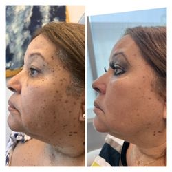 Aguilar Aesthetics Medspa & Wellness - Melasma & Sunspots removal with Colormax Treatment at Aguilar Aesthetics Medspa & Wellness in Aventura, FL